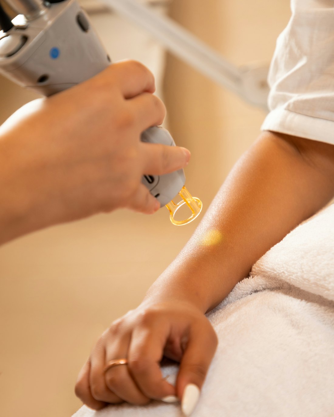 Epilazione laser